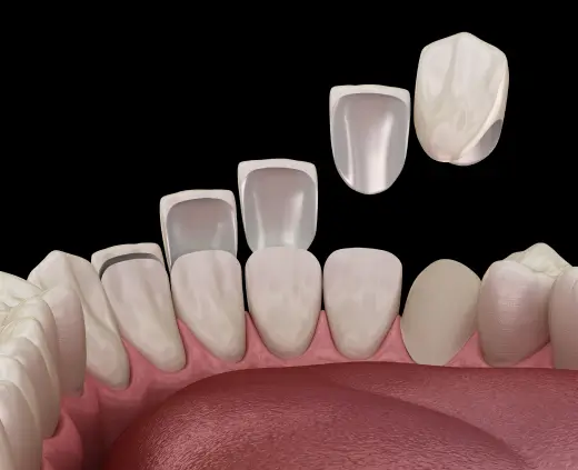 Porcelain Veneers