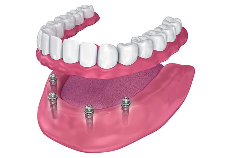 The All-On-4® Technique