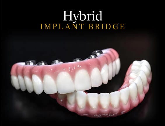 Hybrid Implant Bridge