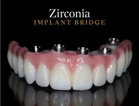 Zirconia Implant Bridge