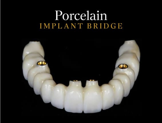 Porcelain Implant Bridge